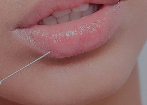 What is Lip Filler?